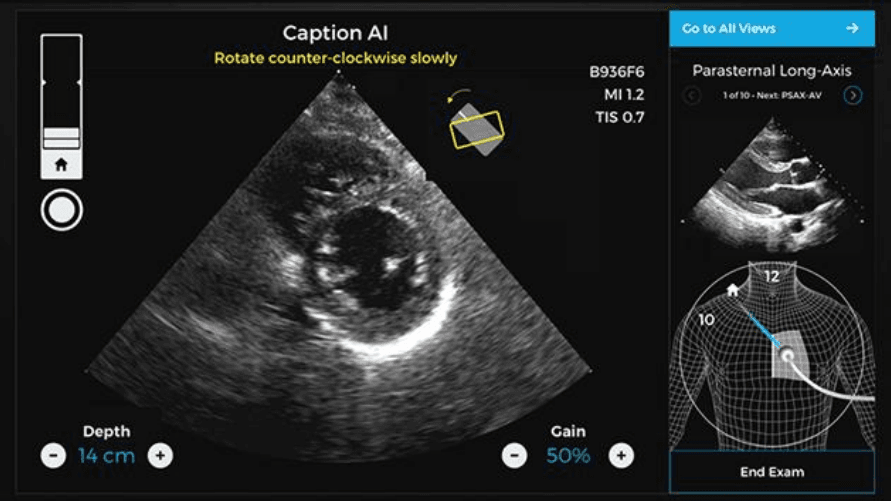 Ultrasound scan interface with Caption AI instructions for rotation and depth measurement.
